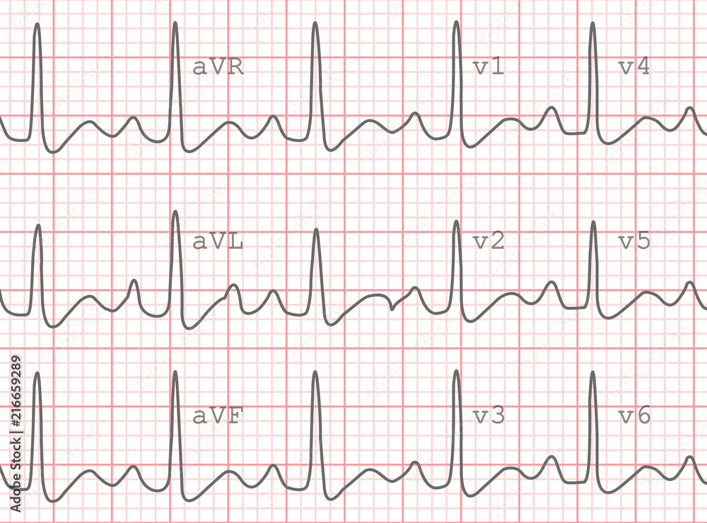 Electrocardiogram, EKG printout, EKG background