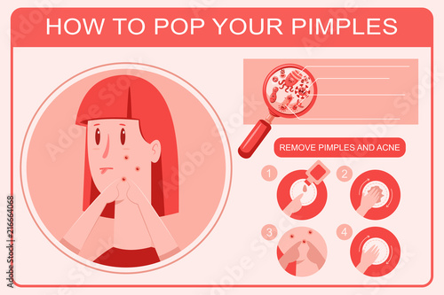 How to pop pimple infographics. Acne skin problem vector cartoon flat medical illustration.