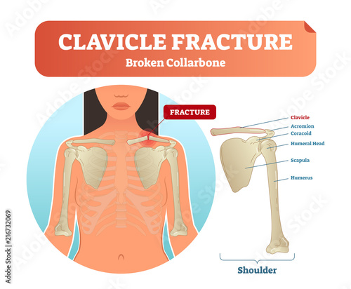 Clavicle fracture with broken collarbone vector illustration. Medical and anatomical labeled scheme with clavicle fracture, acromion, humeral head, scapula and humerus.