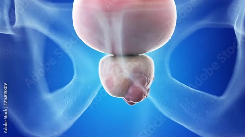 medically accurate 3d animation of prostate cancer