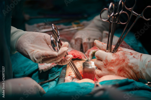Hysterectomy surgery.Team surgeon at work   in operating room.