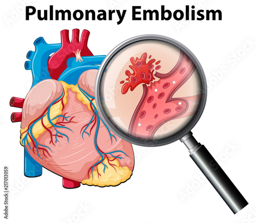 Human anutomy pulmonary embolism