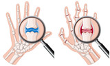 A human hand with rheumatoid arthritis