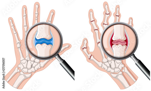 A human hand with rheumatoid arthritis