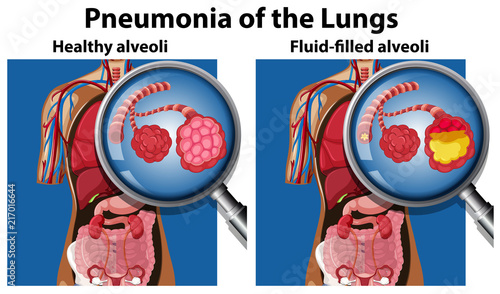 Pneumonia of the lungs concept