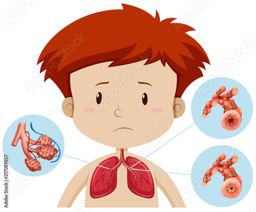 A boy with bronchitis