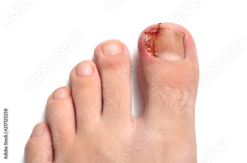 Nail figure, ingrown nail, purulence onychocryptosis. Isolated on white photo