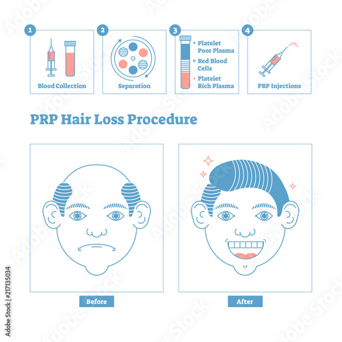 PRP Procedure, men's beauty and health cosmetology scheme. Male baldness issues and solution. Clean design poster with steps. Informative hair loss medical procedure system.