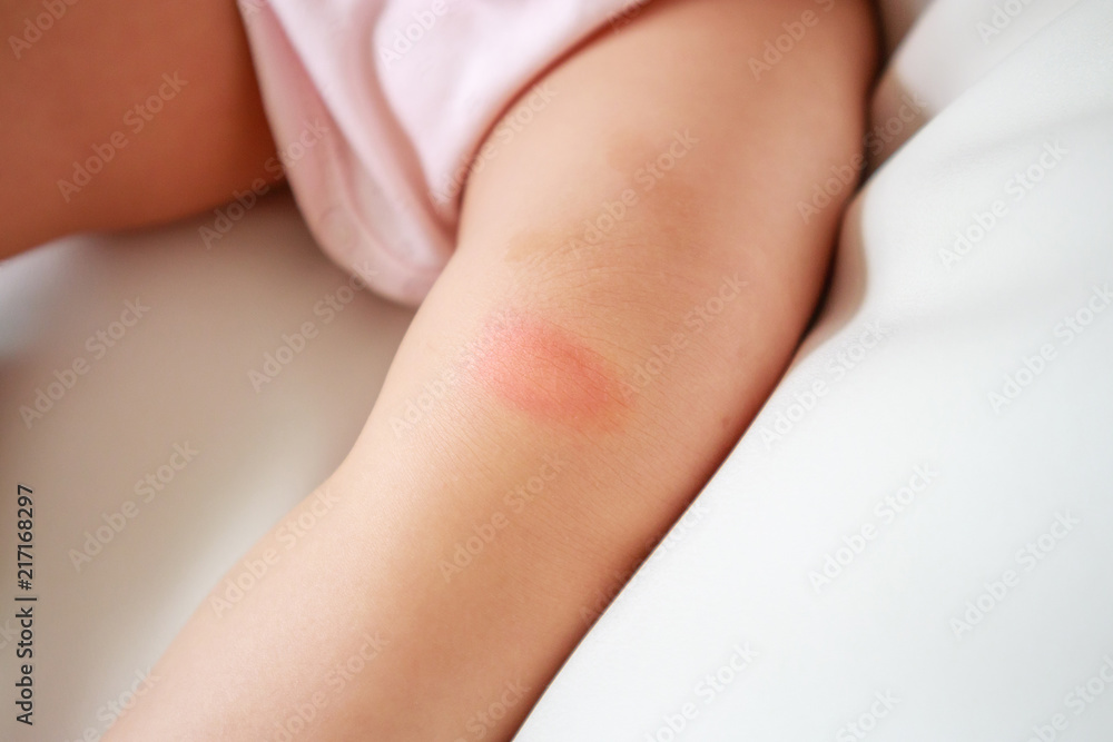 Baby Skin Rash And Allergy With Red Spot Cause By Mosquito Bite At Knee Stock Photo Adobe Stock