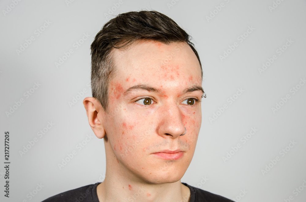 Naklejka premium Portrait of young guy with allergy, with redness face. Close-up.