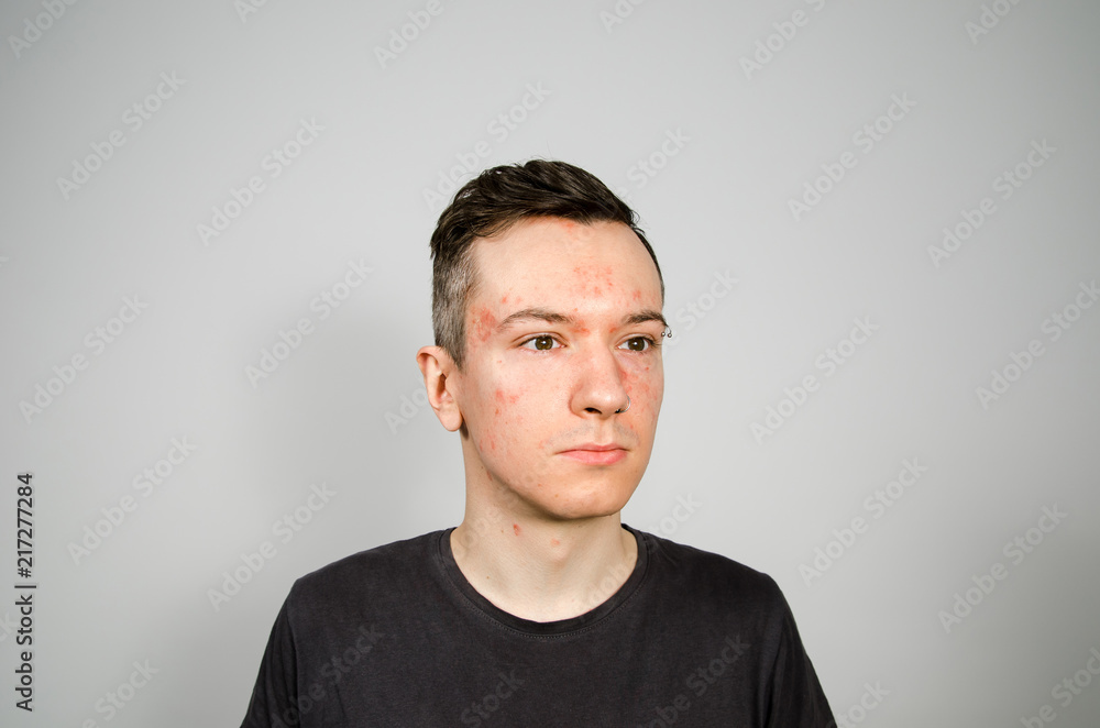 Portrait of young guy with allergy, with redness face Portrait of young guy with allergy, with redness face