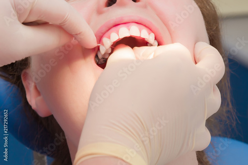 Adult woman visiting a dentist office. Dental hygienist's hands in rubber protective gloves using dental floss for teeth cleaning. Closeup of open mouth.