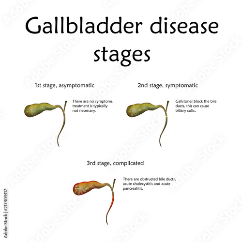 Gallbladder disease stages, inflammation. Gallstones. Cholecystitis. Anatomy vector realistic illustration. White background.