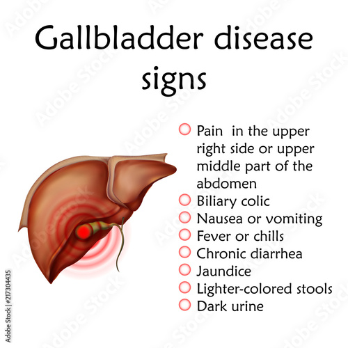 Gallbladder disease signs, inflammation. Gallstones. Cholecystitis. Anatomy vector realistic illustration. White background.