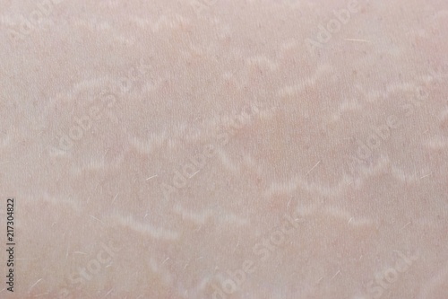 Принти на полотні Striae -Detailed photography of stretch marks on human skin, cosmetic and dermat