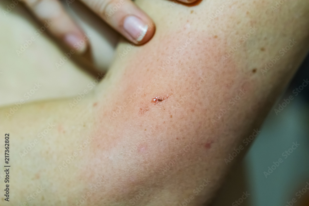 Fototapeta premium Close-up of a young woman's hand biting an insect, having an allergic reaction, redness, itching, swelling and hardening around the bite.