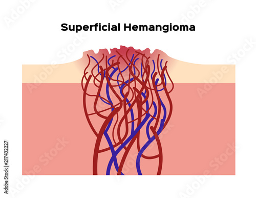 superficial hemangioma vector / organ and anatomy photo