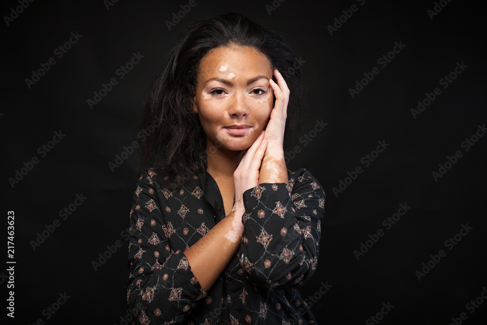 Beautiful African girl with skin problems. Vitiligo concept Beautiful African girl with skin problems. Vitiligo concept