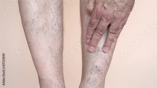 Man checking his veins and capillaries on his leg