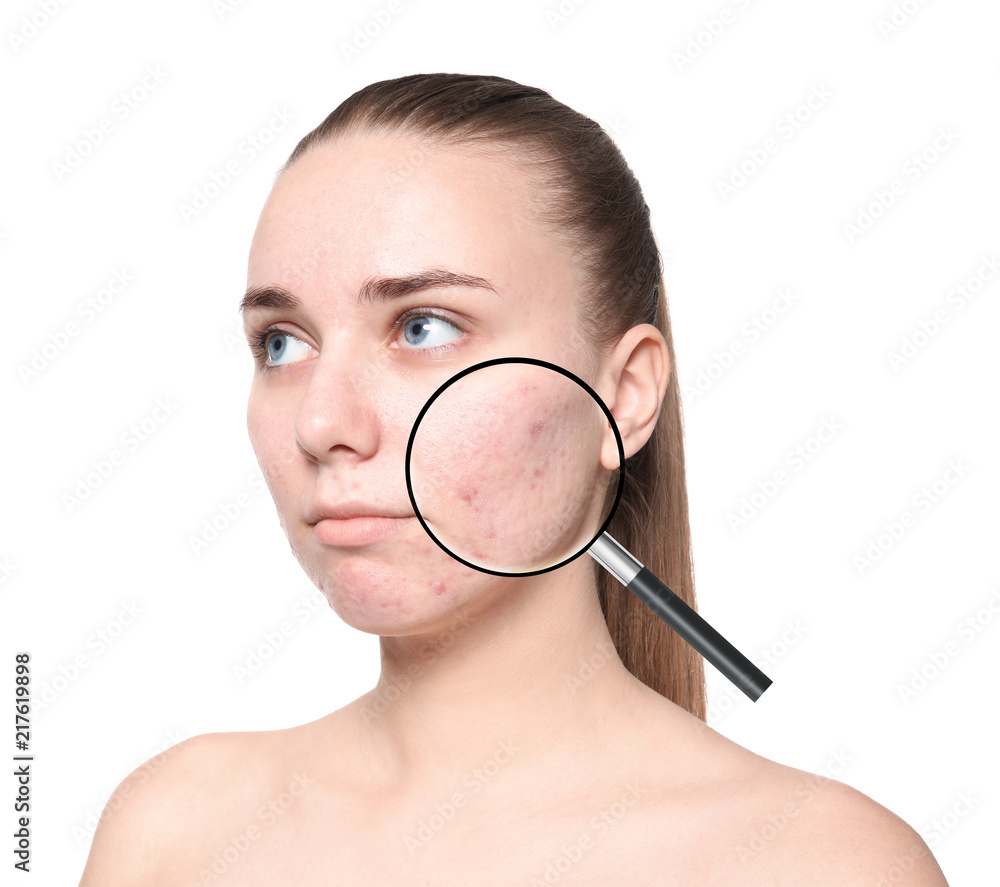 Young woman with acne problem on white background Young woman with acne problem on white background