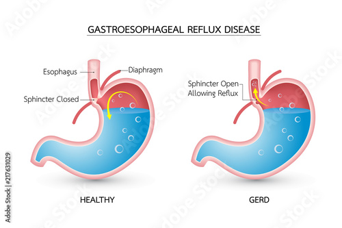 Gastroesophageal reflux disease (GERD). Acid reflux, heartburn and gerd infographic with stomach medical illustration, symptoms, causes and prevention