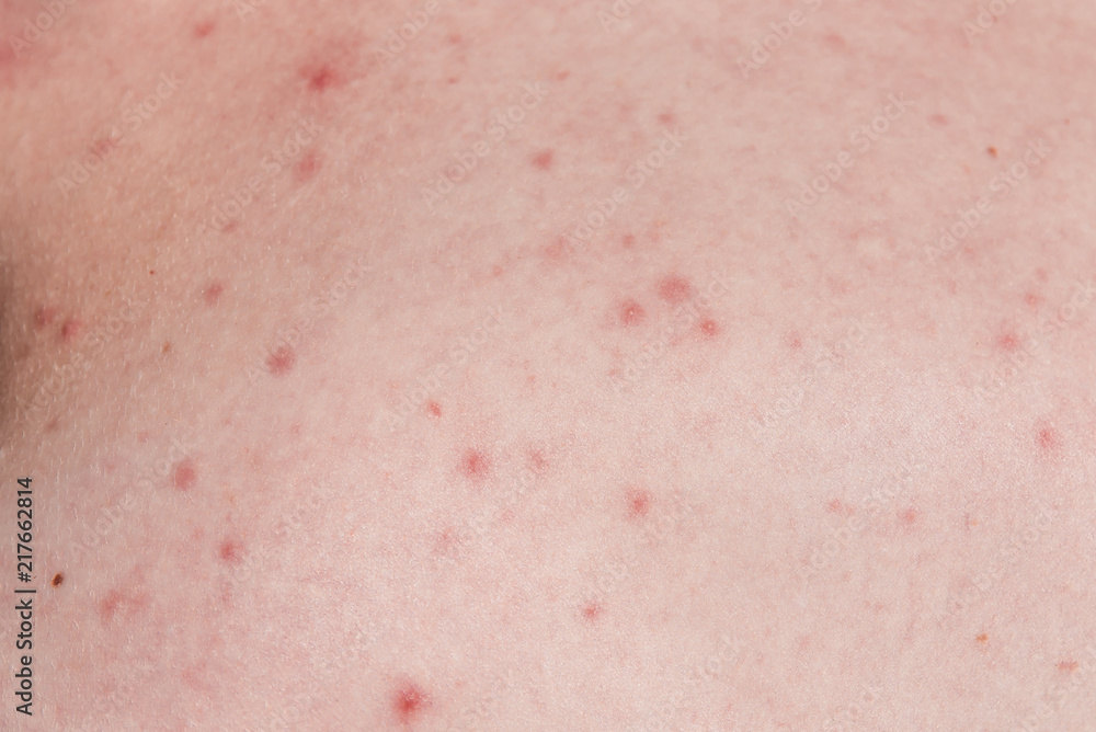 Fototapeta premium Acne on the skin - medical, cosmetic background, the concept of skin cleansing