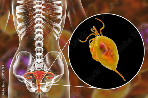 Female trichomoniasis, 3D illustration showing vaginitis and close-up view of Trichomonas vaginalis parasite photo