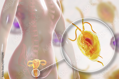 Female trichomoniasis, 3D illustration showing vaginitis and close-up view of Trichomonas vaginalis parasite