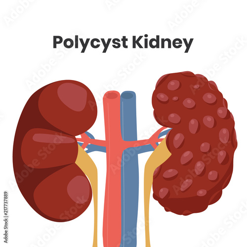 Vector illustration of the polycystic kidney disease,