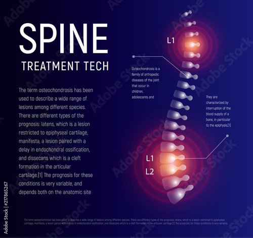 Spine injury treatment, xray human back, healthcare infographic, spinal pain vector illustration.