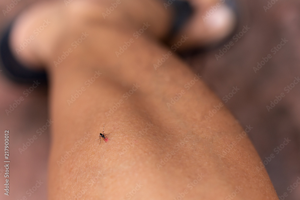 Fototapeta premium Close up of mosquito bite on human leg in the garden.
