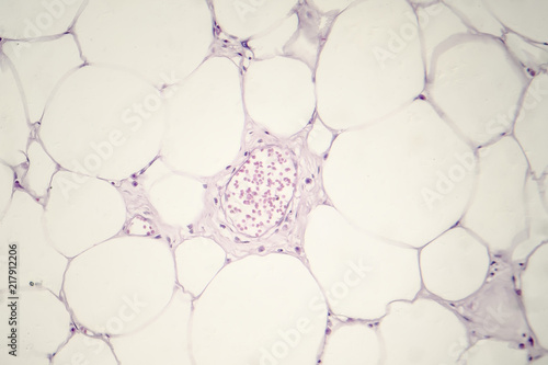 Lipoma, benign growth of fatty tissue, light micrograph, photo under microscope photo