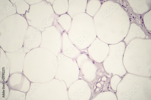 Lipoma, benign growth of fatty tissue, light micrograph, photo under microscope