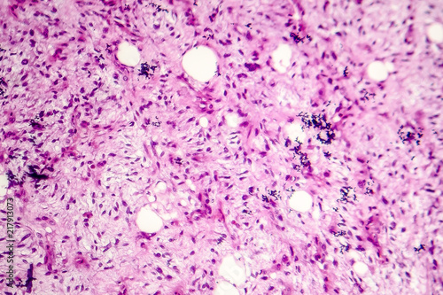Liposarcoma, soft tissue sarcoma, light micrograph, photo under microscope photo