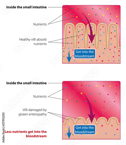 Absorption of nutrients in the small intestine. Healthy and damaged villi. Medical vector illustration