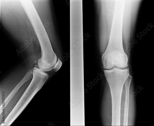 knee with total replacement x-ray image on black background