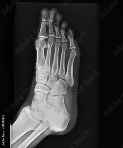 human foot ankel and leg x-ray picture