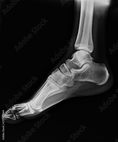 human foot ankel and leg x-ray picture