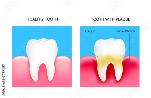 Dental plaque with inflammation and healthy tooth. Illustration isolated on blue background. Dental care concept.