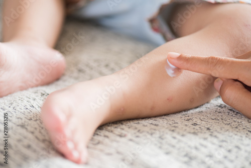 Mother applying cream on a girl's legs with red spot, blister. Medicine and health care concept.