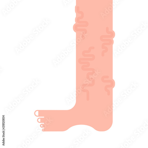 Varicose legs isolated. Veins Disease of foot. Vector illustration