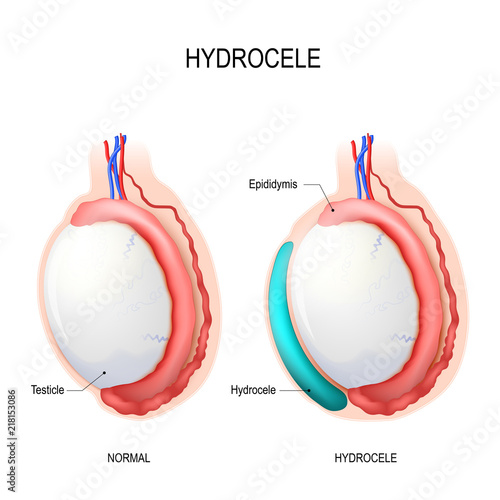 Hydrocele. Testicular disease.