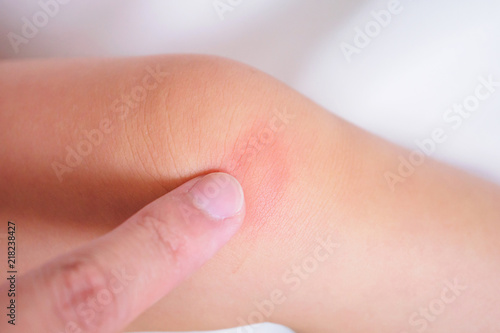 mother apply antiallergic cream at baby knee with skin rash and allergy with red spot cause by mosquito bite