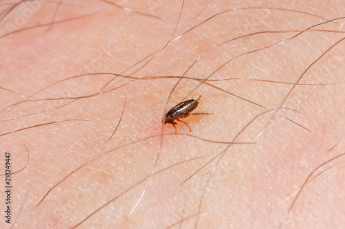a little flea bites on a human photo
