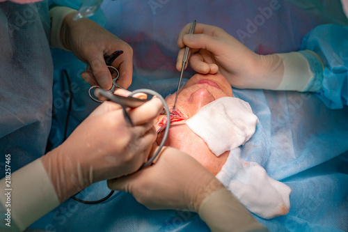Plastic surgery in the operating room. Blepharoplasty