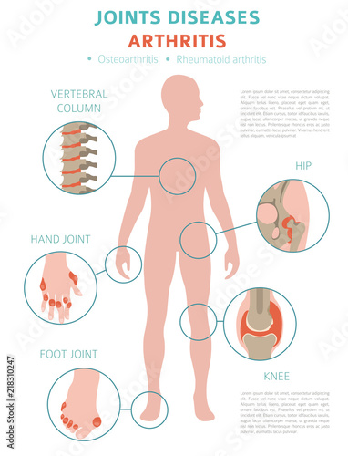 Joints diseases. Arthritis symptoms, treatment icon set. Medical infographic design