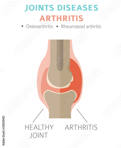 Joints diseases. Arthritis symptoms, treatment icon set. Medical infographic design
