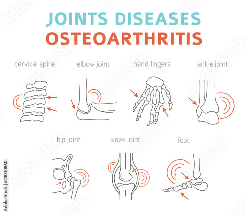 Joints diseases. Arthritis, osteoarthritis symptoms, treatment icon set. Medical infographic design