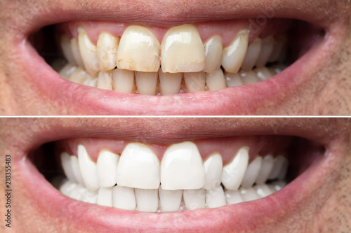 Man Teeth Before And After Whitening