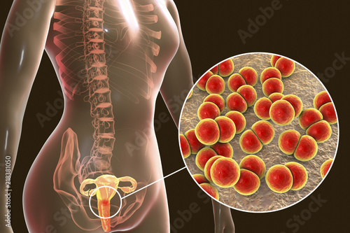 Schilderij op canvas Female gonorrhea, medical concept